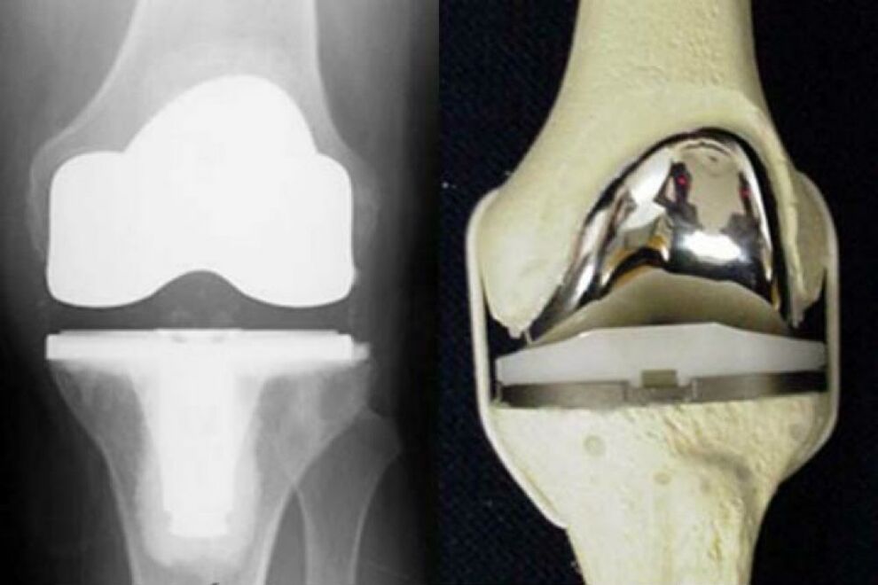replacement of the knee joint for osteoarthritis