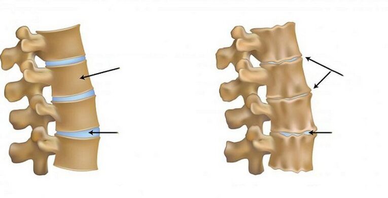 Ischemic syndrome for osteocondrosis