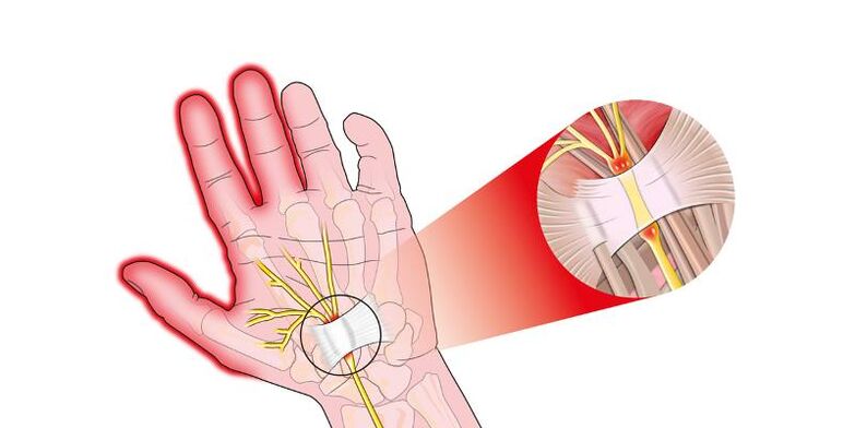 Pain with risisrosis in finger combinations