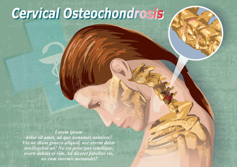 cervical osteochondrosis is the disease of cartilage tissue